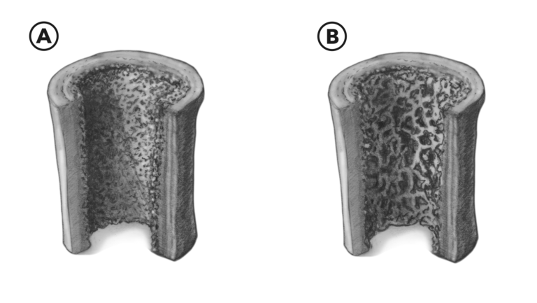 Osteporosis