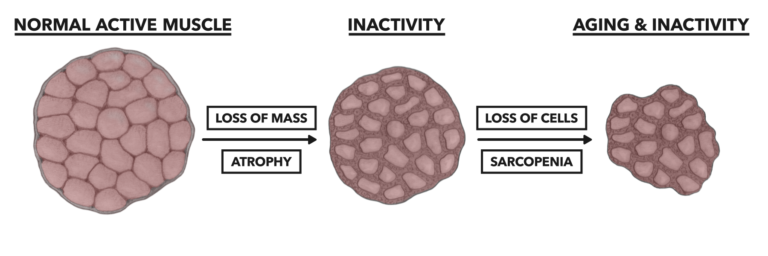 Sarcopenia