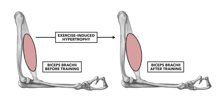 pathological hypertrophy definition