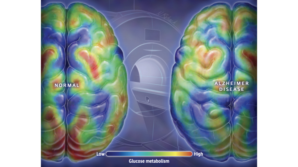 Alzheimer's Brain
